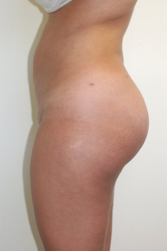 Buttock Enhancement