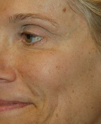 Dysport - The BOTOX Alternative