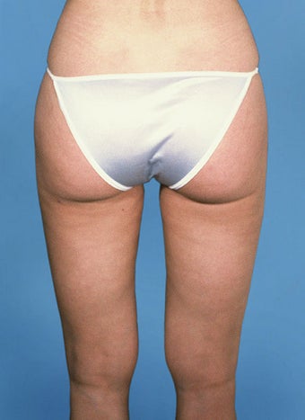 Liposculpture 