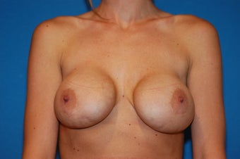 Breast implant exchange and lift