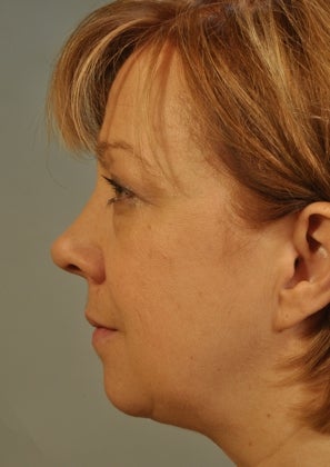 Lower lid Hetter Peel along with upper and lower eyelid surgery. 