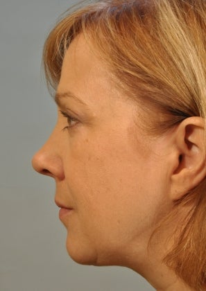 Lower lid Hetter Peel along with upper and lower eyelid surgery. 