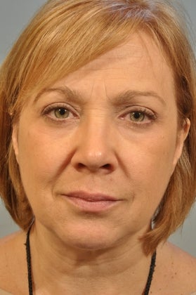 Lower lid Hetter Peel along with upper and lower eyelid surgery. 