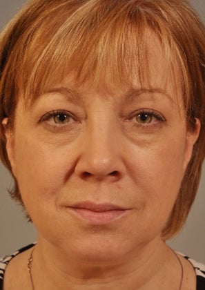 Lower lid Hetter Peel along with upper and lower eyelid surgery. 
