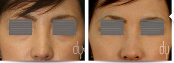 28 year old female treated for lower eyelid bags and prominent tear troughs.  