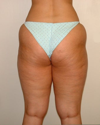 Liposuction