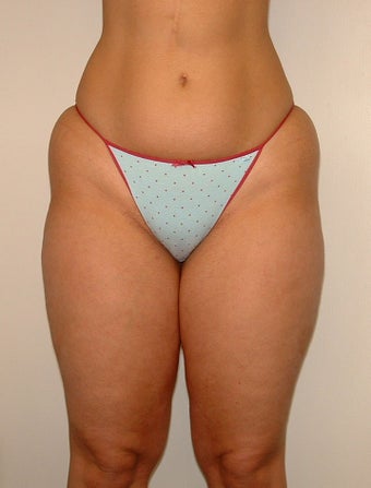 Liposuction