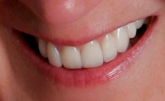 Porcelain Restorations: Bridge, Crowns, and Veneers
