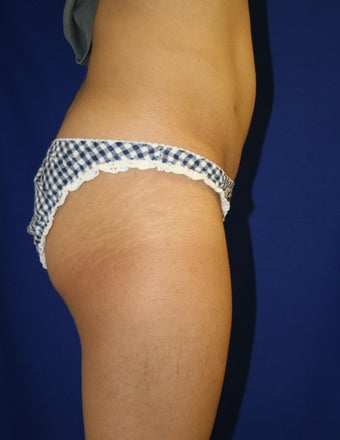 Smartlipo to upper/lower abdomen and hips