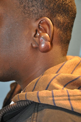 25 year old black male with a recurrent keloid of the ear