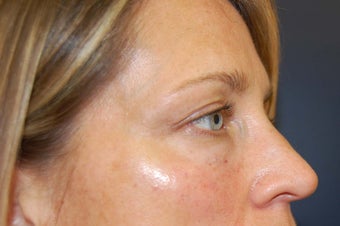 Juvederm dermal filler for upper cheek and under eyes
