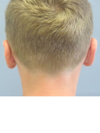 Otoplasty/Ear Surgery