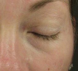Tear Trough after injection with Restylane