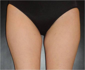 SmartLipo MPX