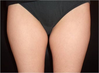 SmartLipo MPX