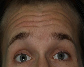 Male treated for Forehead Wrinkles