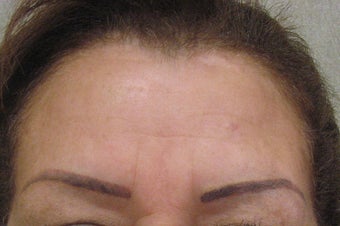 Botox 