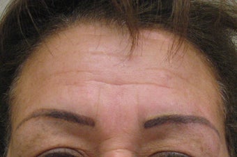 Botox 