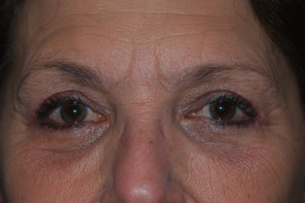Ptosis Repair with combined Lower Lid Blepharoplasty