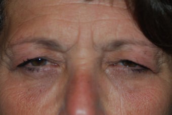 Ptosis Repair with combined Lower Lid Blepharoplasty