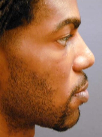 Male Chin Implant 