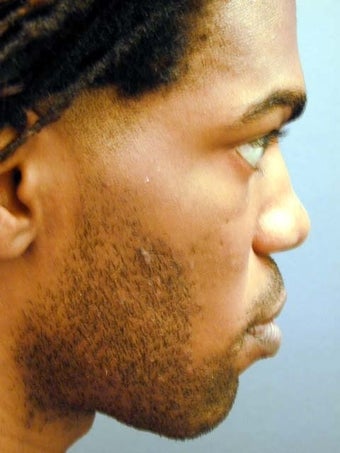 Male Chin Implant 