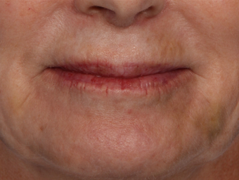 Botox