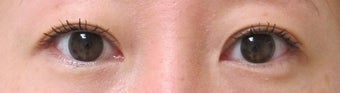 Bilateral Asian Eyelid Surgery