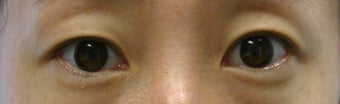 Bilateral Asian Eyelid Surgery