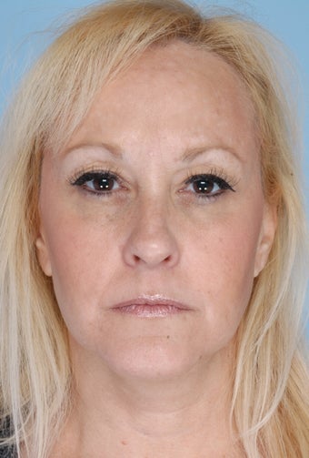 Botox
