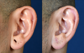 Stretched Earlobe Repair