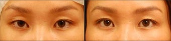 Asian Eyelid Surgery for Uneven Crease