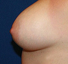 Breast Augmenttion