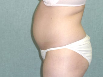 SmartLipo tummy and hip roll - laser assisted
