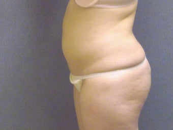 SmartLipo tummy and hip roll - laser assisted