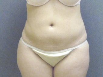 SmartLipo tummy and hip roll - laser assisted
