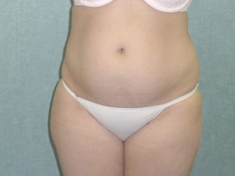 SmartLipo tummy and hip roll - laser assisted