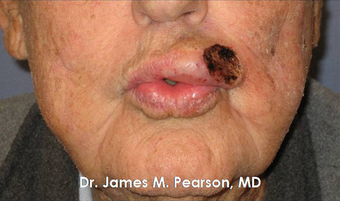 Lip Reconstruction