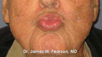Lip Reconstruction