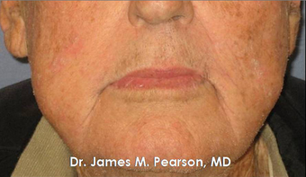 Lip Reconstruction