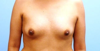 Breast Augmentation 36-year-old female