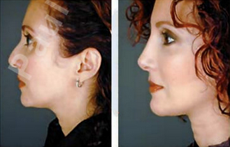 Complete Facial Rejuvenation