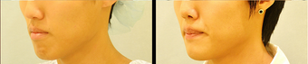 Chin Augmentation