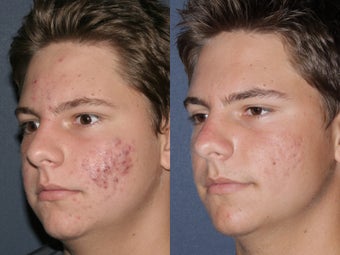 Photodynamic therapy and Fraxel Restore