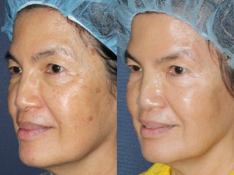 63 year old Asian female with brown spots and sun damage with Fraxel Dual and Alex laser