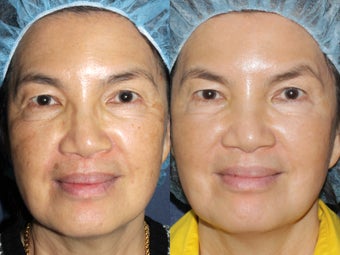 63 year old Asian female with brown spots and sun damage with Fraxel Dual and Alex laser