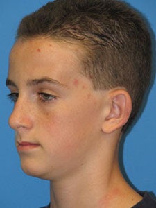 Otoplasty Ear Surgery - Boy