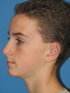 Otoplasty Ear Surgery - Boy