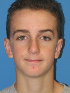 Otoplasty Ear Surgery - Boy