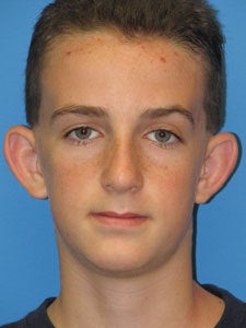 Otoplasty Ear Surgery - Boy